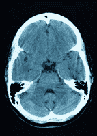 SPECT brain imaging