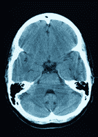 brain research may unlock autism spectrum disorder facial perception